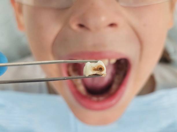 Best Emergency Tooth Extraction in Carlisle, KY